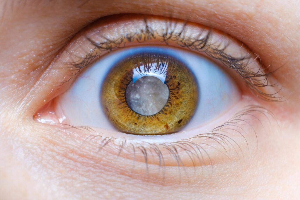 Katarakterkrankung bei einer Frau. Augenarzt Zürich - Seeaugenpraxis Horgen