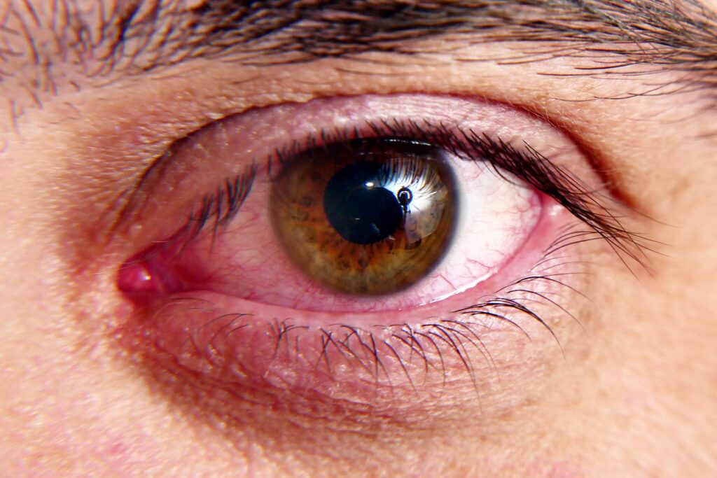Rote Eichhörnchenaugen, Makroaufnahme. Infektion im Auge, platzende Gefäße des Auges.