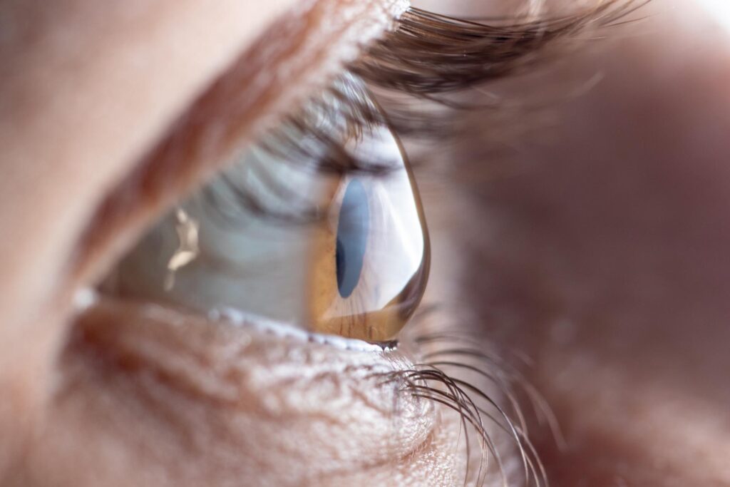Makro-Auge. Augenerkrankung - Keratokonus. Augenarzt Zürich - Seeaugenpraxis Horgen